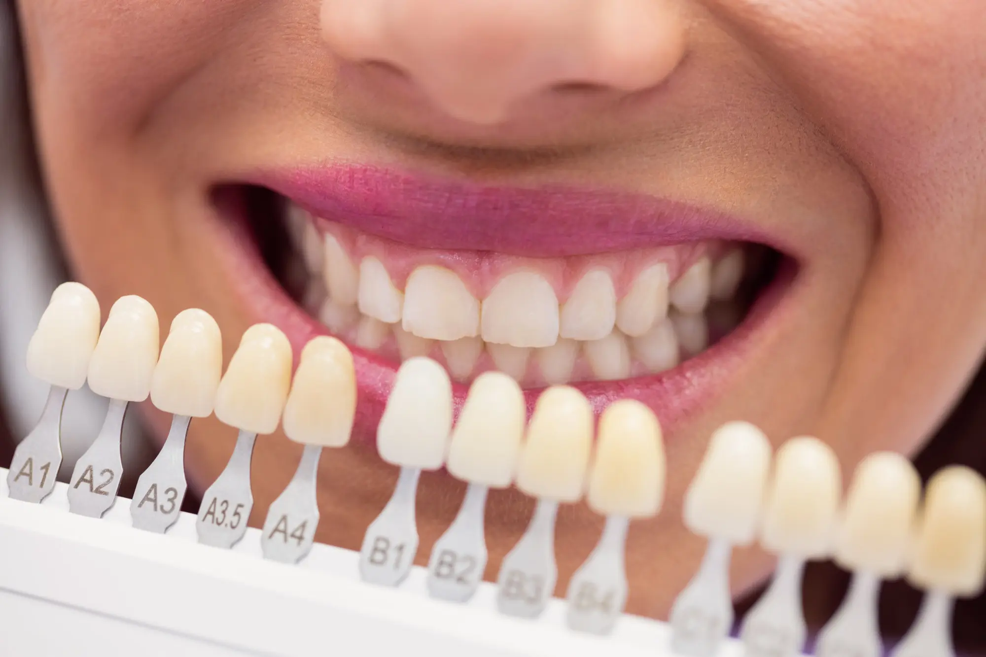 All Ceramics & Metal Ceramic Crown Restoration